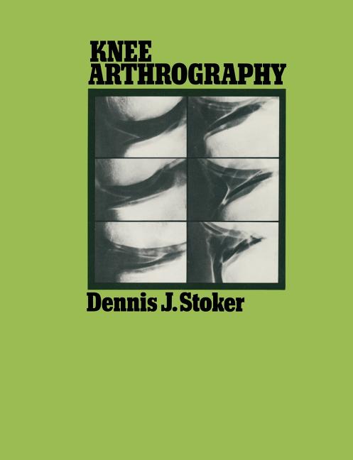 Knee Arthrography (Softcover Reprint of the Original 1st 1980)