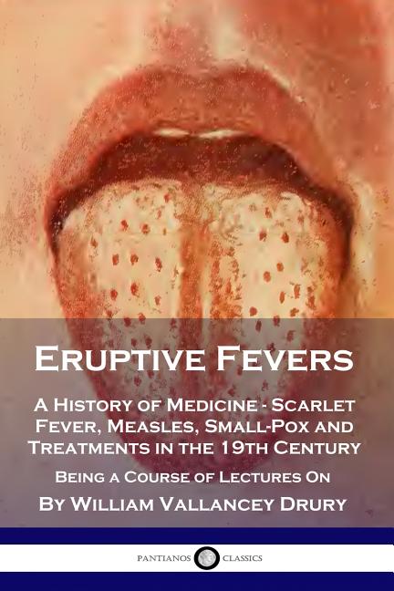 Eruptive Fevers: A History of Medicine - Scarlet Fever, Measles, Small-Pox and Treatments in the 19t